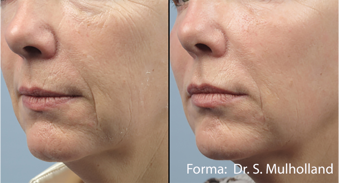 What is the Best Nonsurgical Treatment for Jowls?