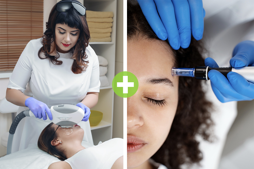 Double-Duty Beauty: Combining IPL Photofacial and Microneedling for Maximum Results!